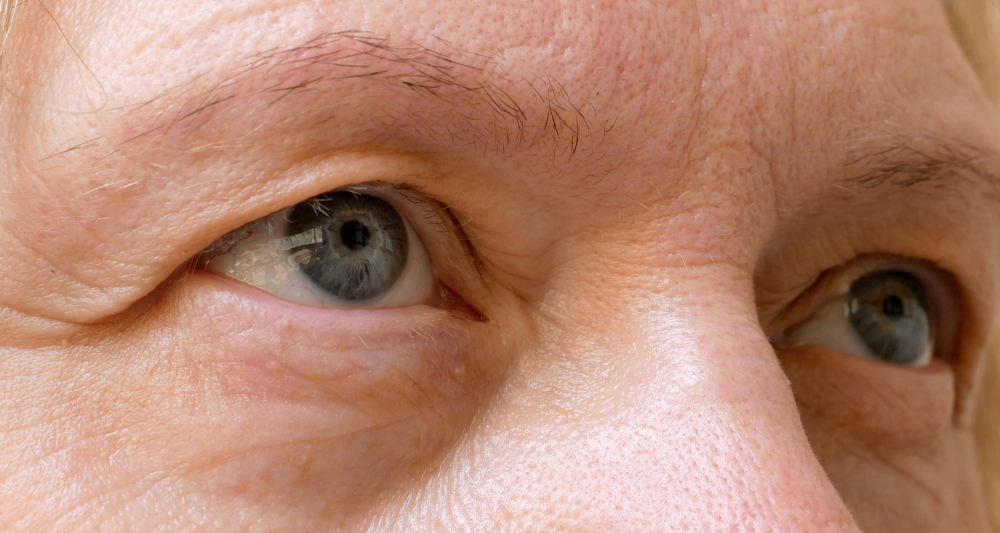 droopy (1) Droopy Eyelid treatments