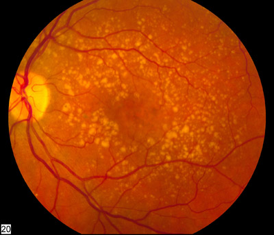 Age-Related Macular Degeneration (ARMD) diagram